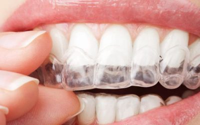 Una paziente ci parla dei nostri allineatori dentali trasparenti .. ascoltate, vi piacerà!!